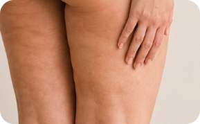 Tratamento de Lipedema